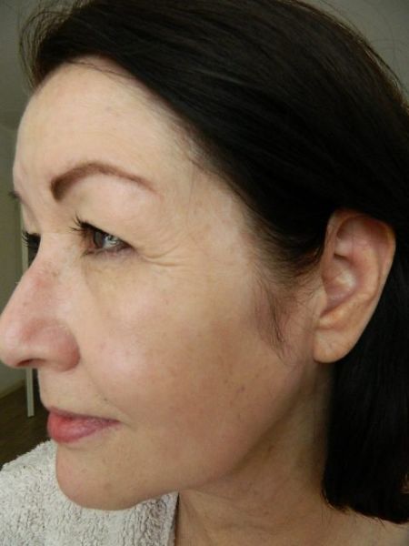 overhangend ooglid babs