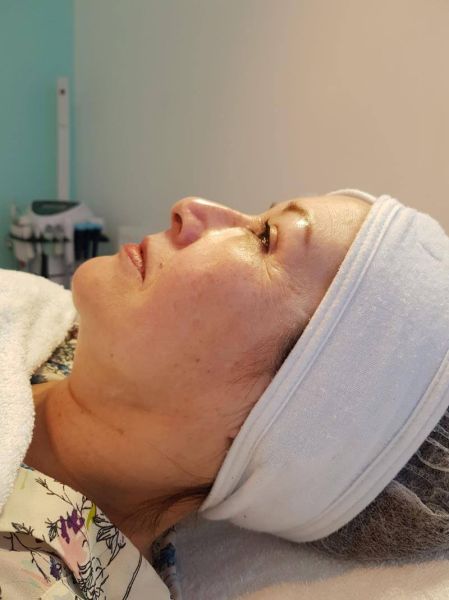 perfect age beauty center tiel quanis dermafiller